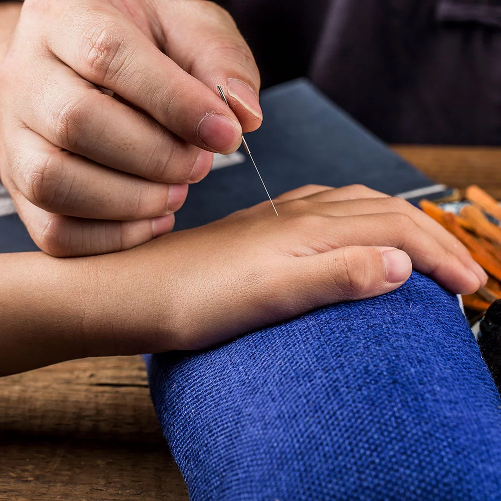 acupuncture treatment on child's hand